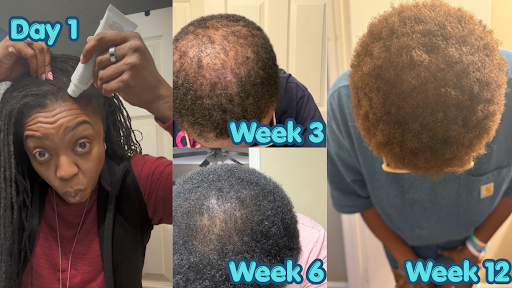 Progress timeline from day 1 to week 12 showing a fuller crown