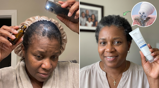 Before and after: thinning crown on the left, fuller crown holding the OrréNaturals ampoule on the right