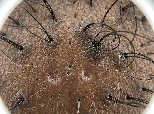 Close-up scalp microscopy showing hardened tissue around hair follicles