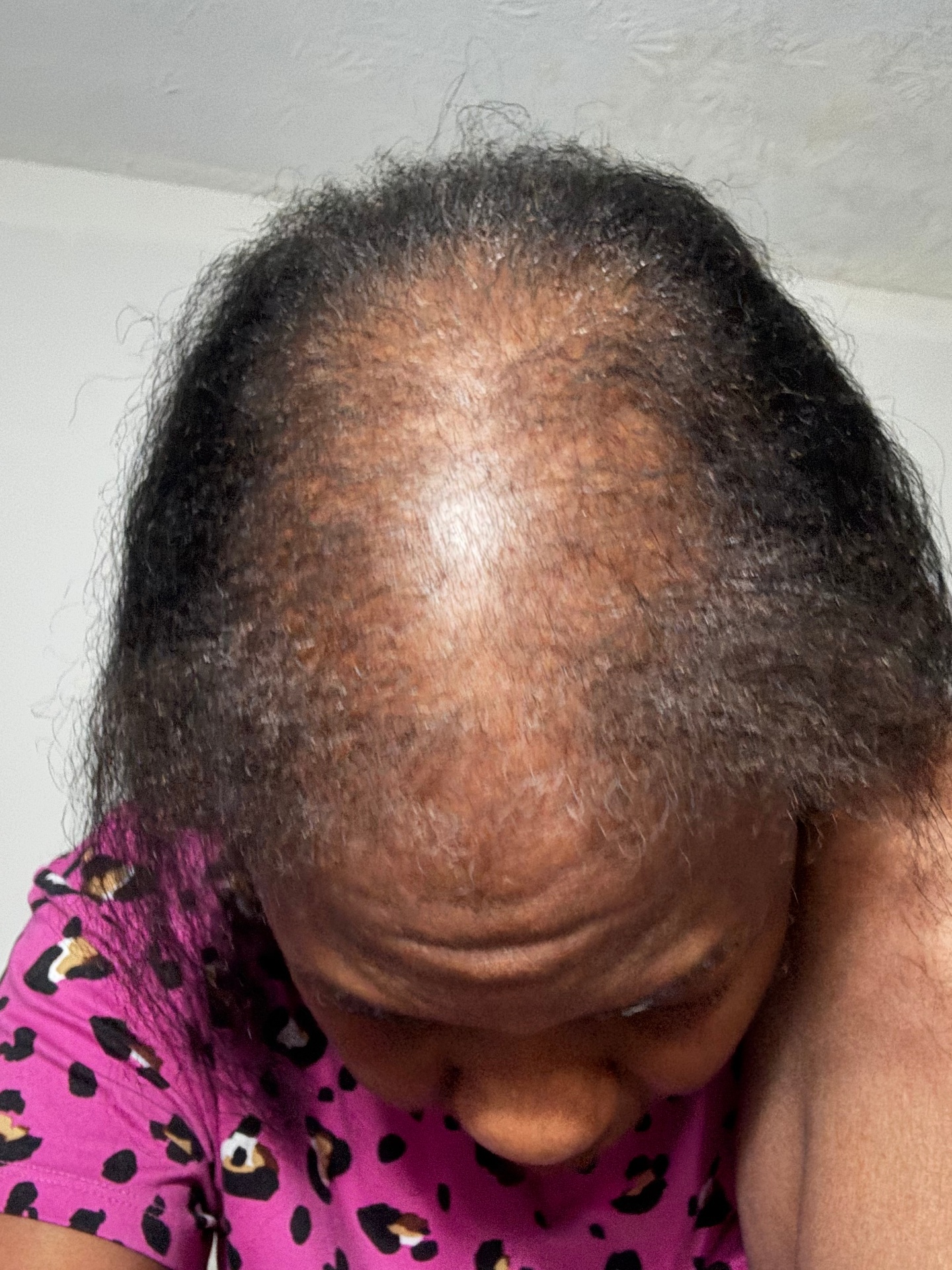 Yvette before using the OrréNaturals Hair Revival Ampoule