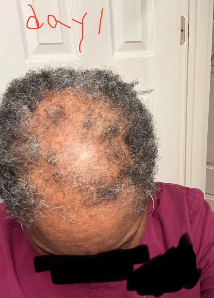 Karen before using the OrréNaturals Hair Revival Ampoule