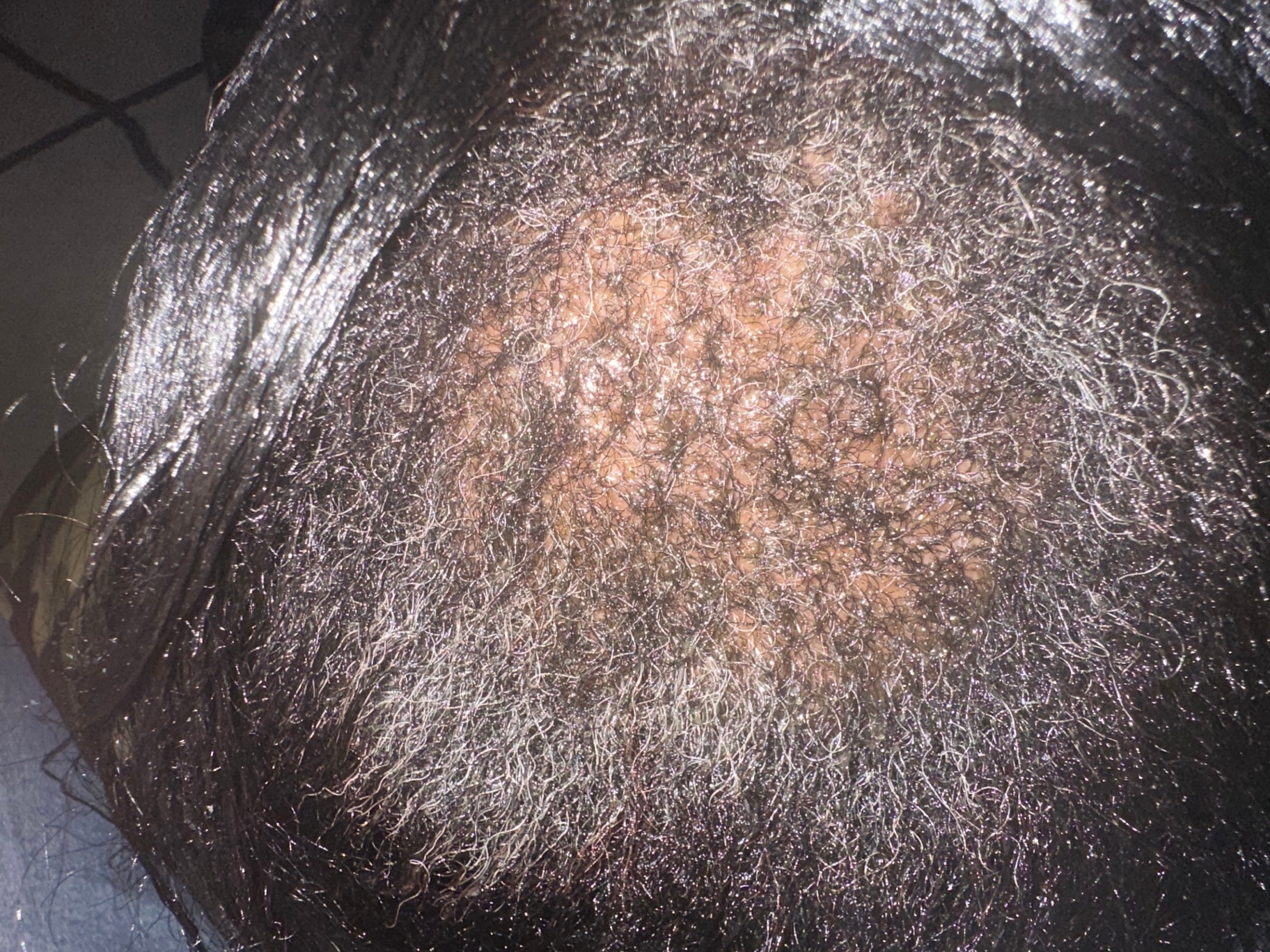 Janelle before using the OrréNaturals Hair Revival Ampoule