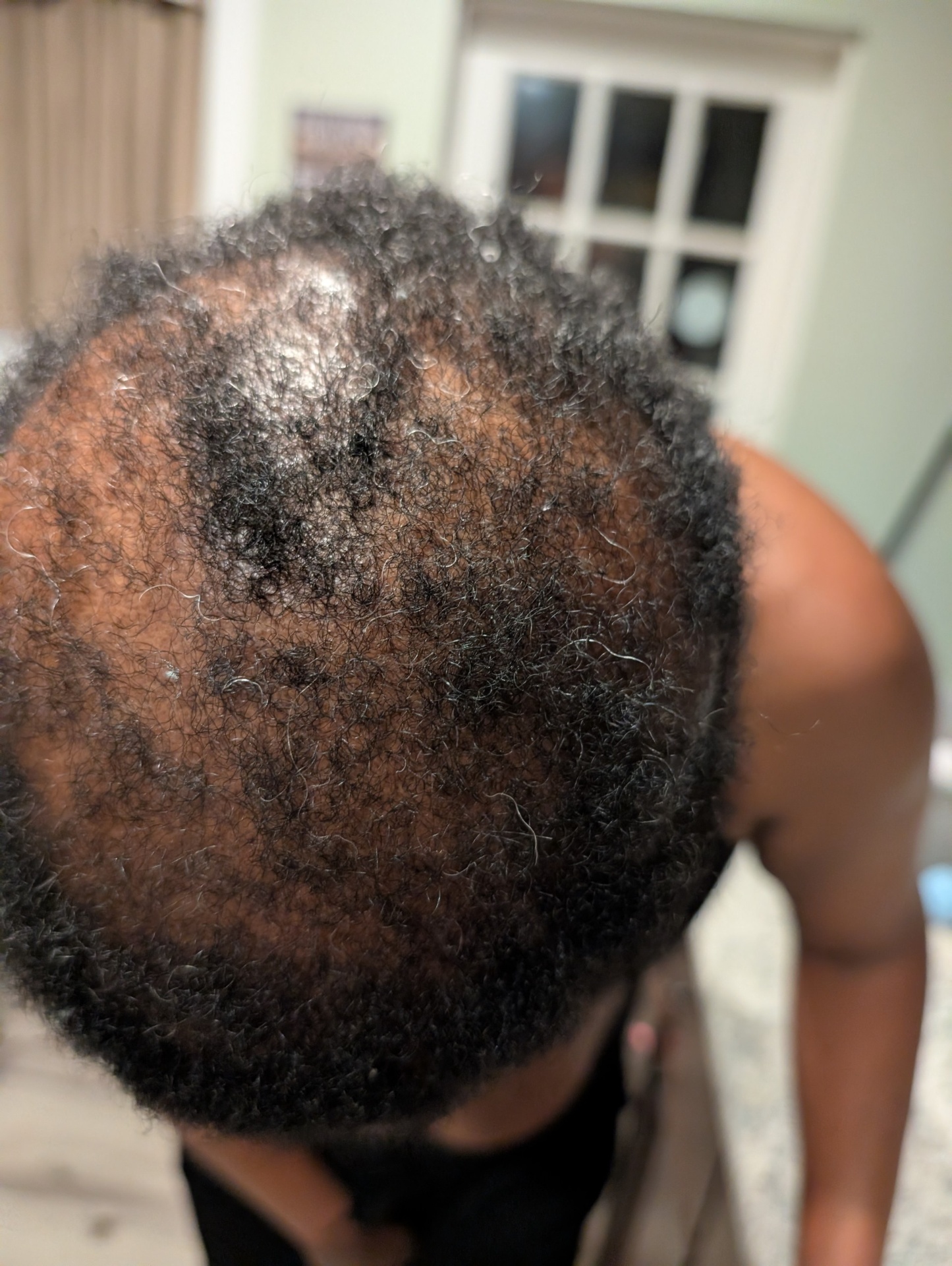 Cheryl after using the OrréNaturals Hair Revival Ampoule